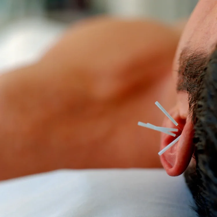 Ear acupuncture treatment session at Shelley Jones Acupuncture, Coxley, Wells