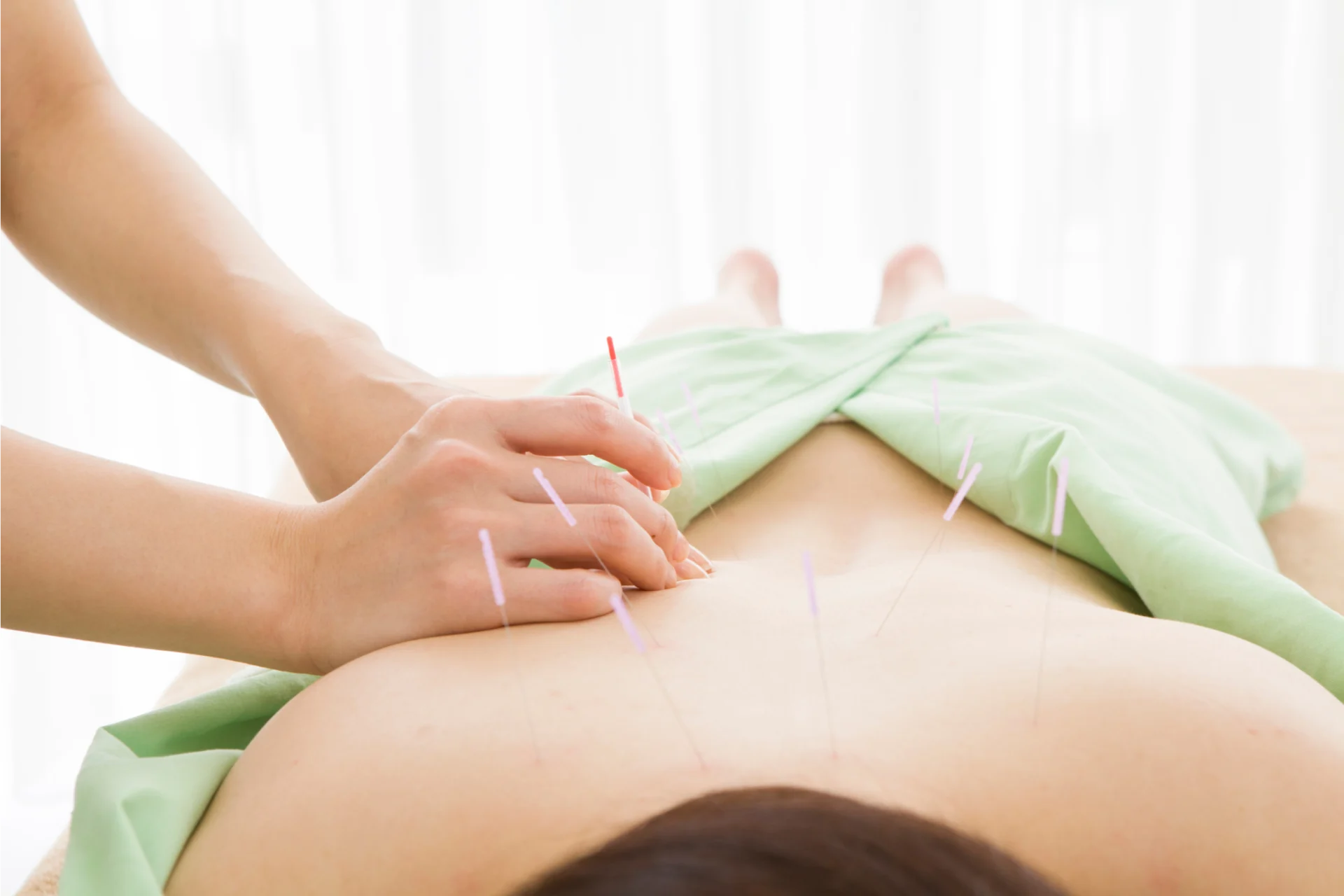 Acupuncture treatment session at Shelley Jones Acupuncture, Coxley, Wells